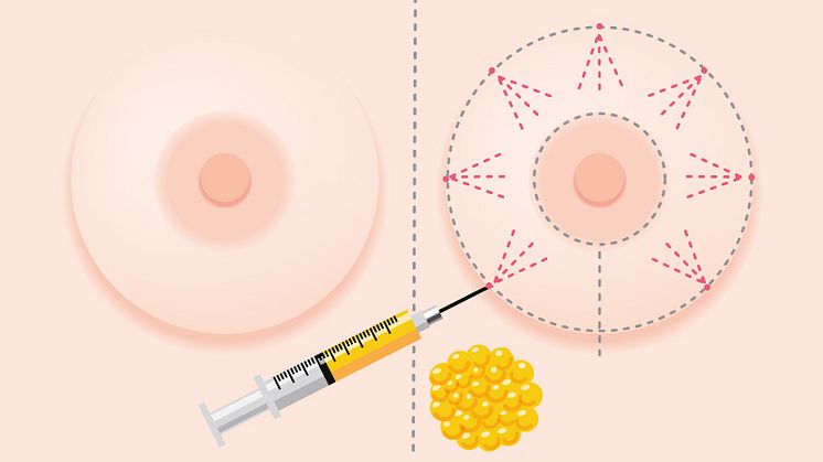 Will the Effects of Fat Grafting Last?