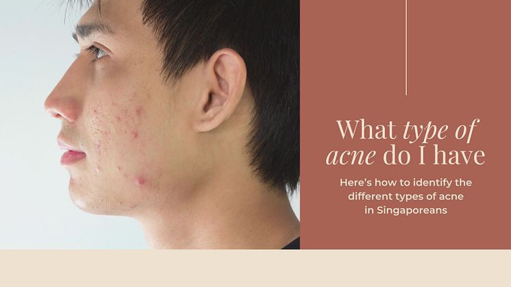 What type of acne do I have | Here’s how to identify the different types of acne in Singaporeans