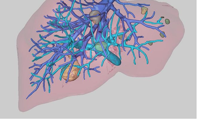 Cancerkirurgi i levern med röntgensyn