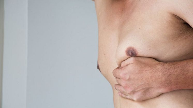 All you need to know about gynecomastia