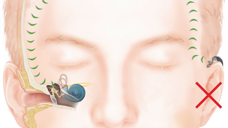 Wie das Hören mit einem Baha Knochenleitungsimplantat bei einseitigem Hörverlust funktioniert