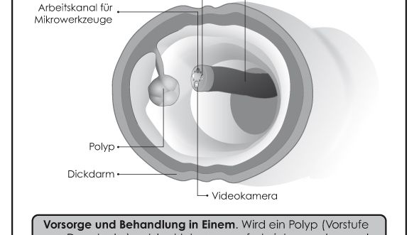 Darmkrebsvorsorge mittels Darmspiegelung