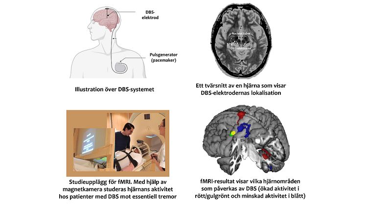 DBS, djup hjärnstimulering