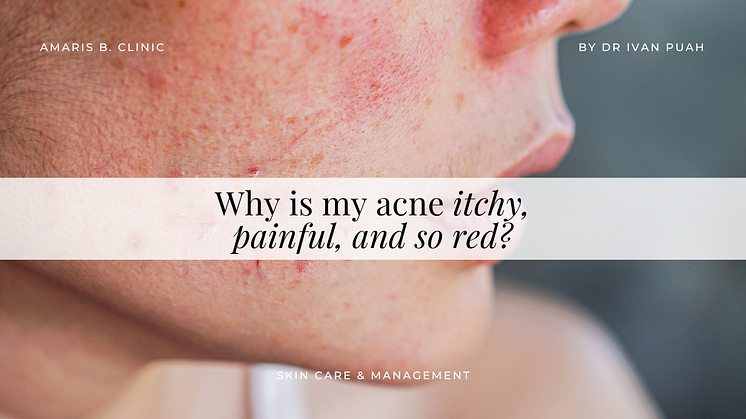 Why is my acne itchy, painful, and so red?