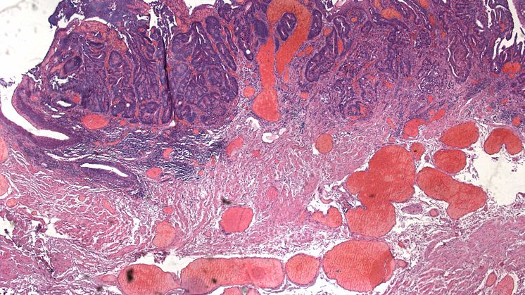 Rektumkarzinom - Malignitätsgrad 1 (histologisches Foto)