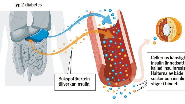 Diabetes uppmärksammas i ny kampanj av Hjärt-Lungfonden