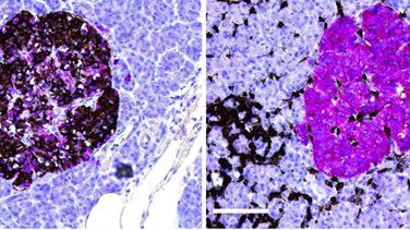 Bilden är tagen ifrån studien: Insulitis in human diabetes: a histological evaluation of donor pancreases.