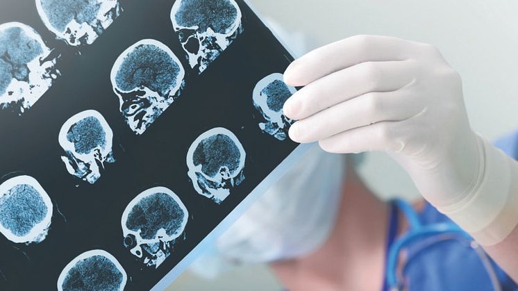 Nu närmar vi oss den första bromsmedicinen mot Alzheimer: Vad betyder genombrottet för patienter och sjukvården?