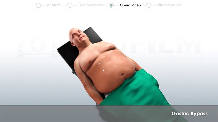 Informationsfilm om Gastric Bypass-operation