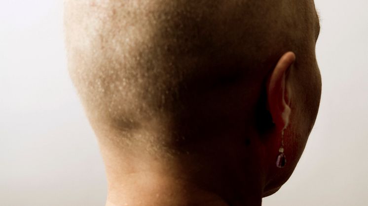 För de som drabbas av sjukdomen alopecia areata kan det dröja månader eller år innan håret växer tillbaka. Foto: Johnér Bildbyrå