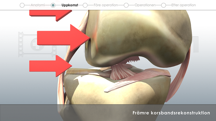 Främre korsbandsrekonstruktion