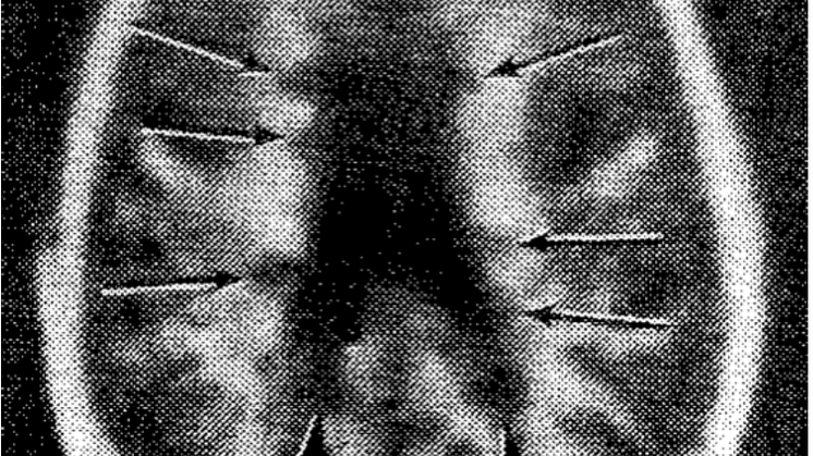 Young-MRI-MS-1981_fig5