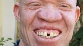 Barn med albinism lever farligt i Tanzania