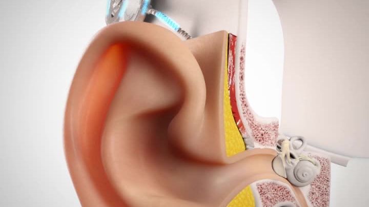Wie funktioniert ein Cochlea-Implantat?