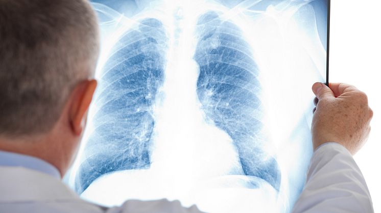Enligt Strålsäkerhetsmyndigheten drabbas 500 personer årligen av lungcancer till följd av radon i vår inomhusluft