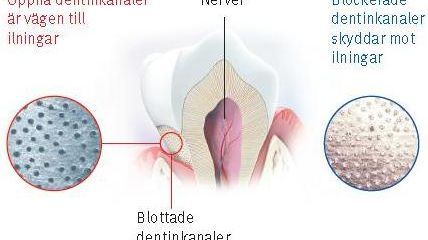 Iningar i tänderna och dentilkanaler, nyhetsgrafik