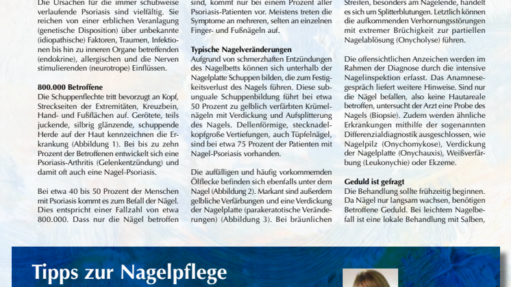 Psoriasis: ungewollte Tüpfel an Finger- und Fußnägeln