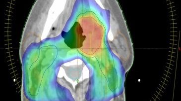 Ett tvärsnitt ur en strålbehandlingsplan för en patient med huvud- och halscancer. Bild: Varian Medical Systems.