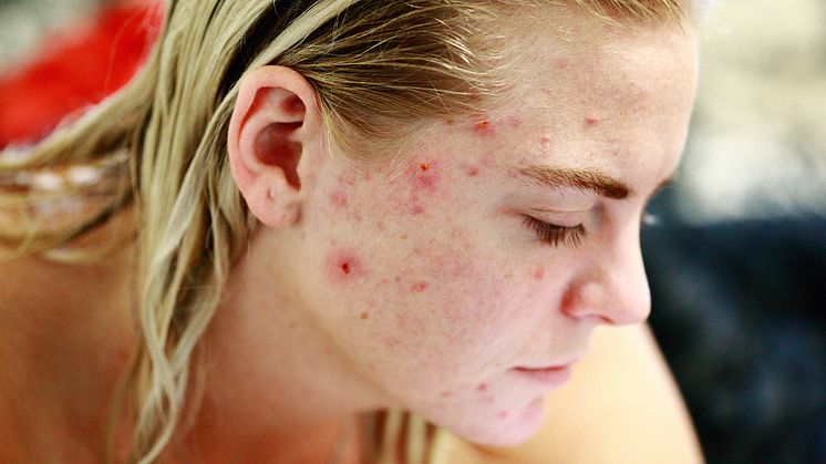 Den starka aknemedicinen isotretinoin bedöms nu som säker trots tidigare larm. Bild: Pixabay. CC0