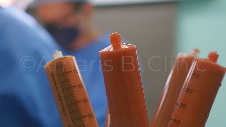 Dr Ivan Puah Recommends Fat Grafting As A Solution Following Post-surgery Scars or Disfigurement