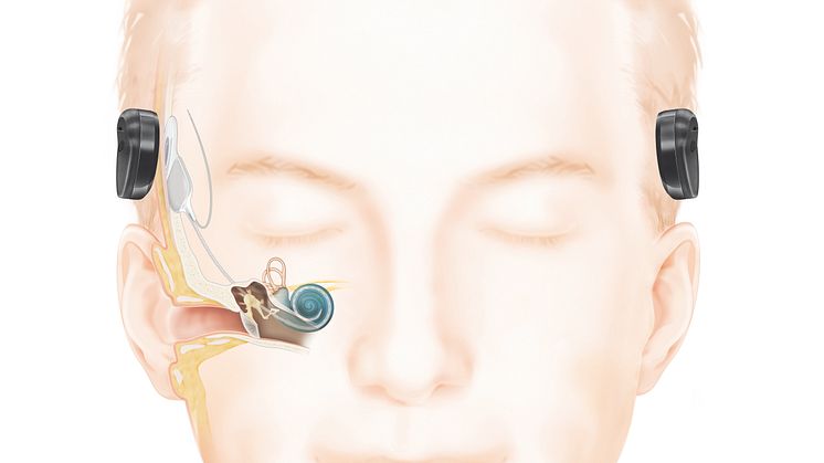 Wie das Hören mit einem Cochlea-Implantat (frei vom Ohr) funktioniert