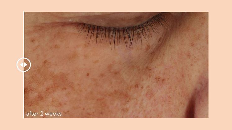 Dr Dennis Gross Overnight Texture Renewal Peel Edu.mp4