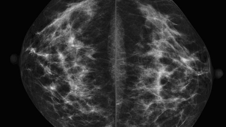 Invandrarkvinnor uteblir från mammografi  - dör oftare i bröstcancer
