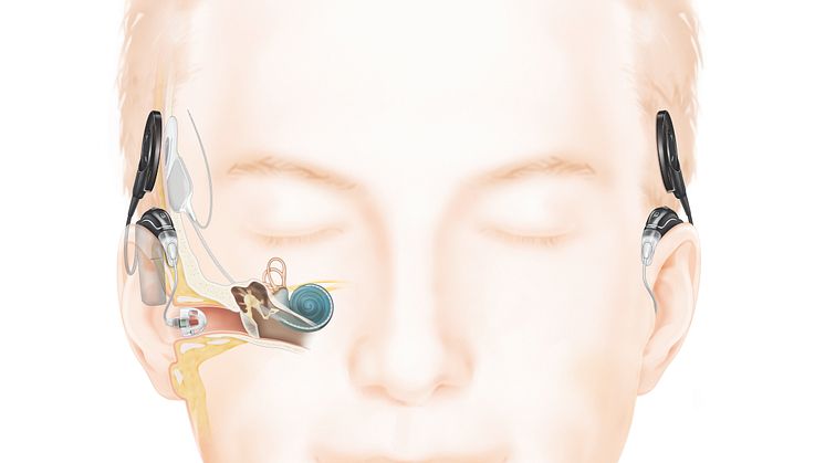 Wie das Hören mit einem Cochlea-Implantat mit Akustikkomponente funktioniert