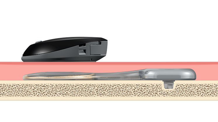 Schaubild - Cochlear™ Osia® System