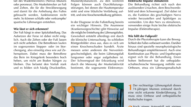 Gehen wie ein Storch: der Lähmungsfuß