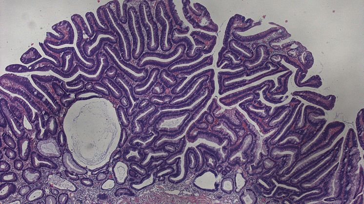 Tubuläres Adenom des Kolon (histologisches Foto)