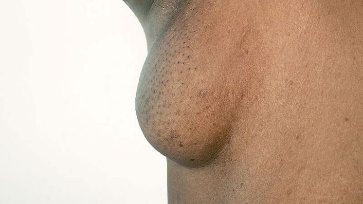 Is Accessory Breast Tissue Harmful? All You Need To Know