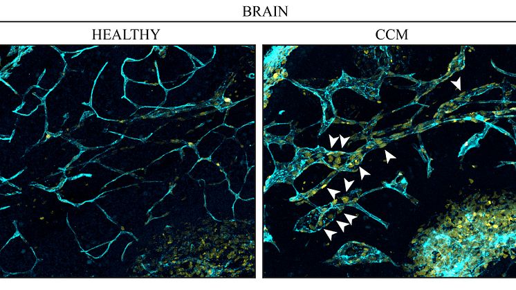 Blood vessels in a brain. Left: endothelial cells (turquoise blue) from a healthy brain. Right: cavernoma leads to increased cell division in the endothelial cells (nucleus marked yellow) in the veins and causes malformations. Photo:Fabrizio Orsenigo
