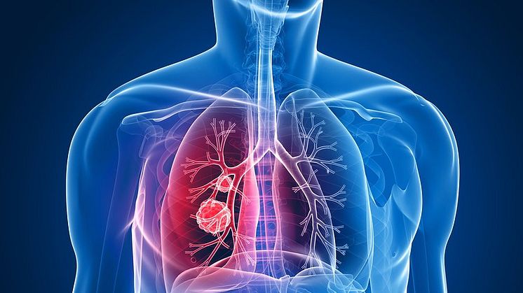 lung-cancer