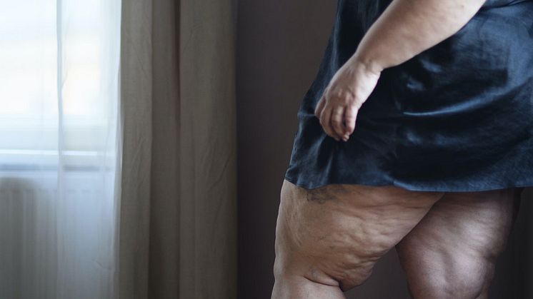 How Much Weight Loss Causes Loose Skin?