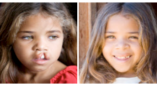 Praktikertjänst hjälper Operation Smile att sprida leenden