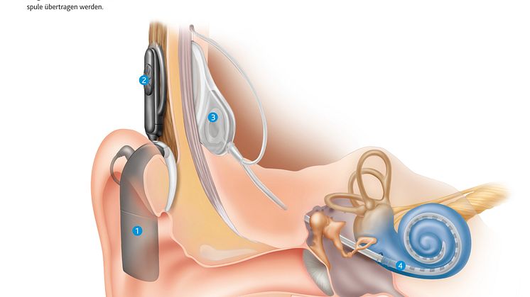 Wie das Hören mit einem Cochlea-Implantat funktioniert