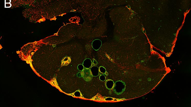 Propranolol treatment contributes to reduced number and size of cerebral cavernous malformations. The lesions are outlined in green. Photo: Joppe Oldenburg