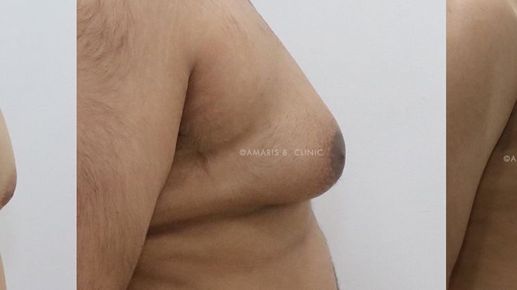 Adolescent gynecomastia: Diagnosis for teenagers with gynecomastia