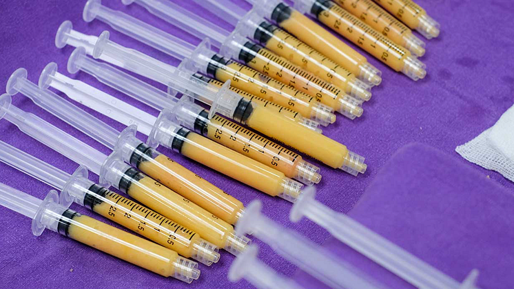 Facial Fat Grafting – The Next Big Thing?