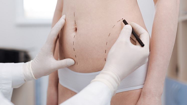 A less invasive form of liposuction : Modern Liposuction With MDC-SCULPT®️ Lipo Technique