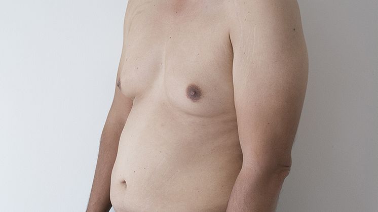 Do You Have Fat DNA? Fight it with Liposuction!