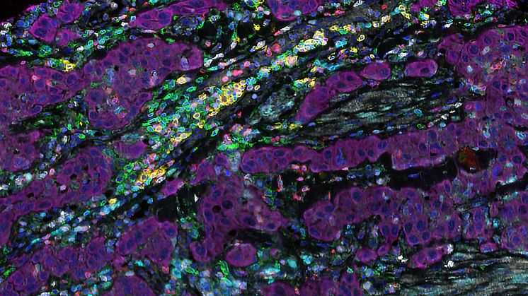 Human tumour tissue