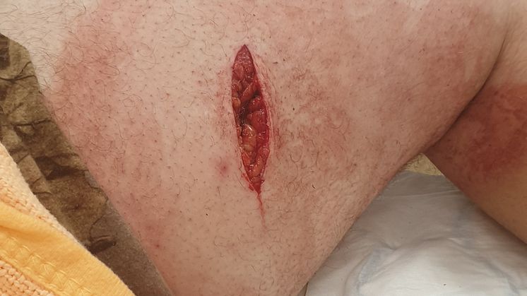 VIldsvinsgaltens bete gav ett rejält sår