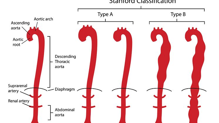 AdobeStock_Gesunde-Aorta-im-Vergleich-mit-Aortendissektion-Typ-A-und-B_Stanford-Klassifikation