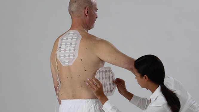 Vid TTFields-behandling appliceras givare, så kallade transducer arrays, på huden över området där tumören är belägen.