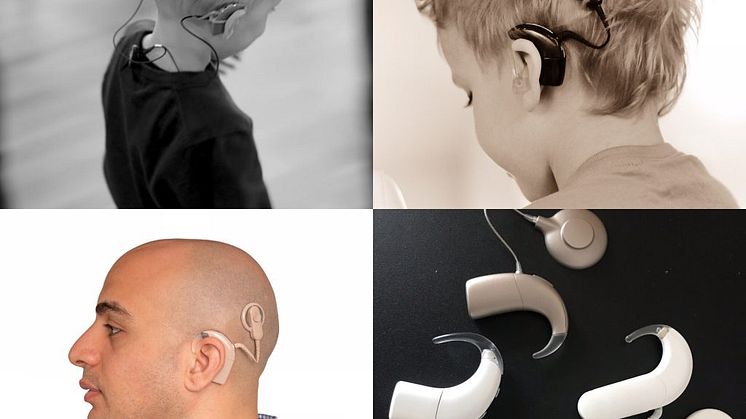 Patienter med cochleaimplantat prioriteras 