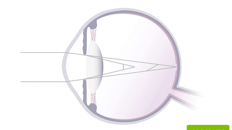 astigmatism_web