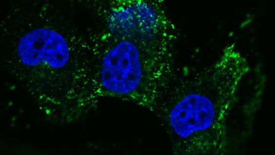 Cisplatinresistenta Malignt Pleuralt Mesoteliom-celler med Gb3 (grönt) på cellytan.