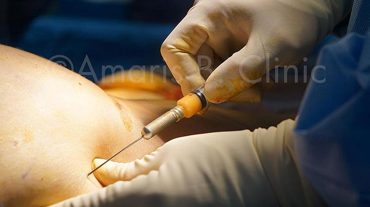 All  You Need To Know Before You Go For  A Fat Transfer Procedure in Singapore